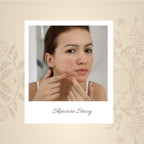 acne prone skin