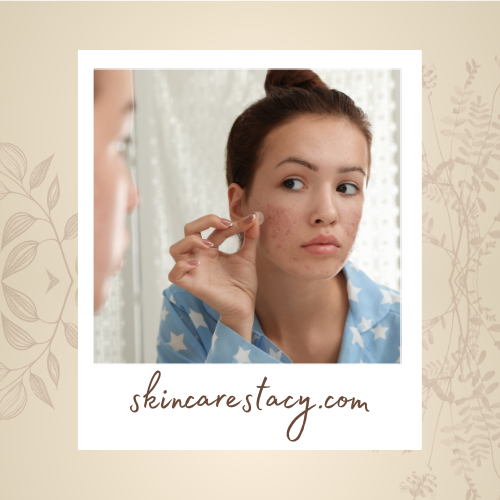 Woman putting on a pimple patch